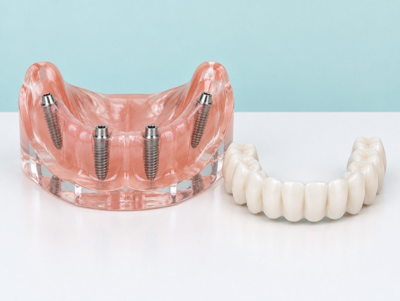 Educational jaw model with four implants, the back two tilted, next to a full-arch bridge (not a Nobel Biocare product image)