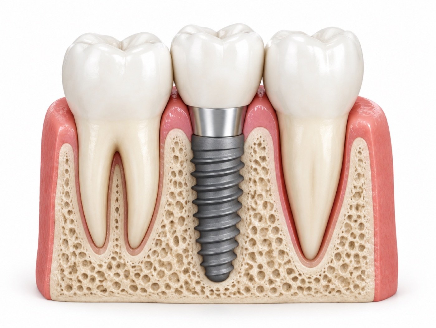 Diagram of implant, abutment and crown (illustration)